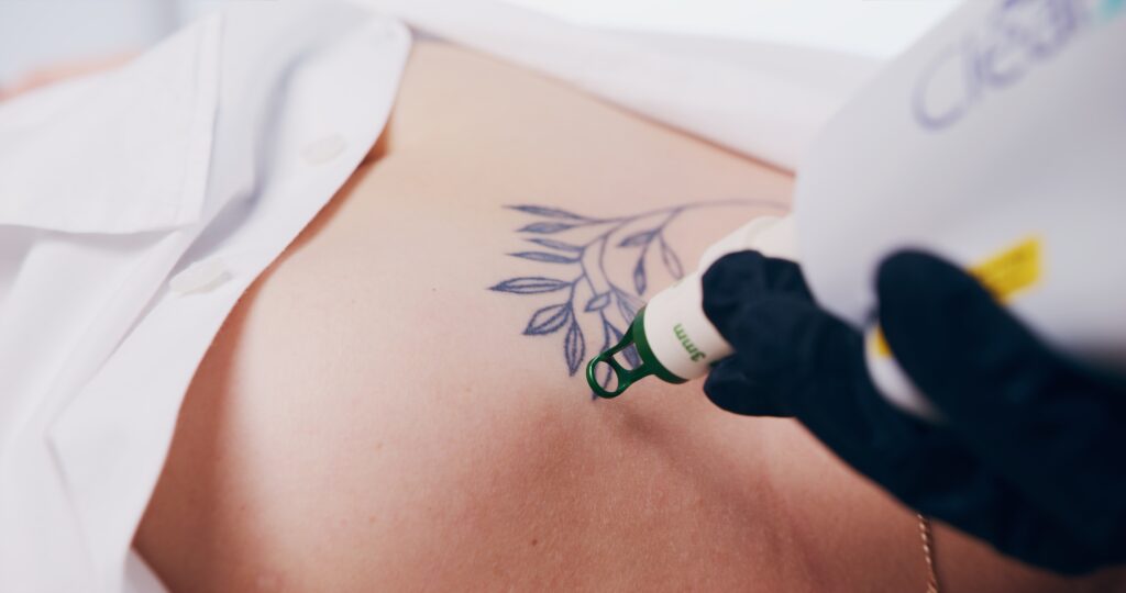 laserowe usuwanie tatuażu Kielce